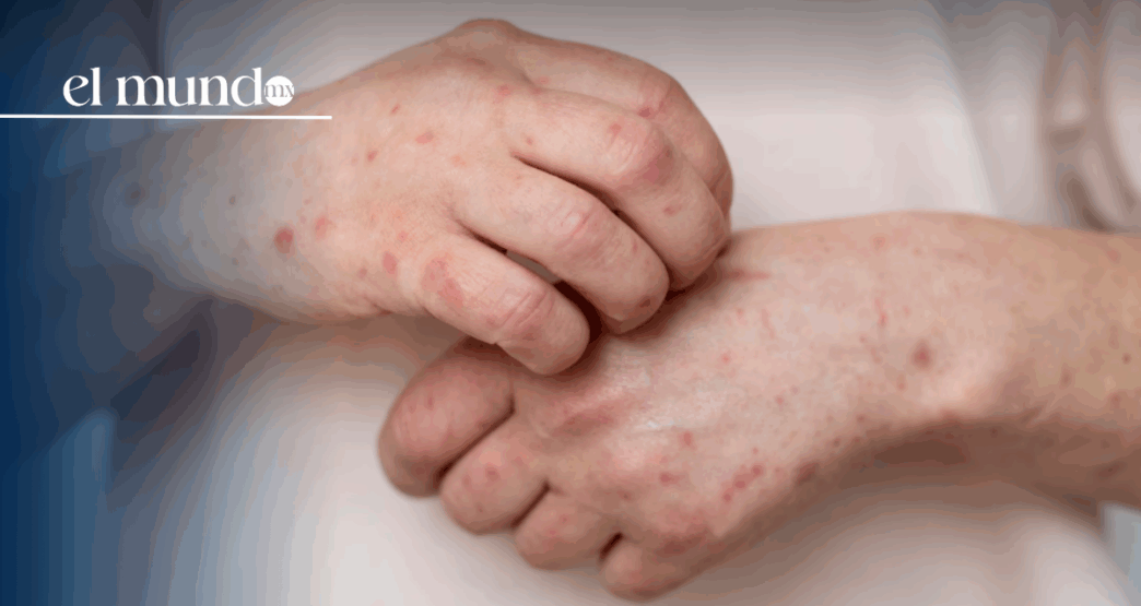 Sarampión en México 2026